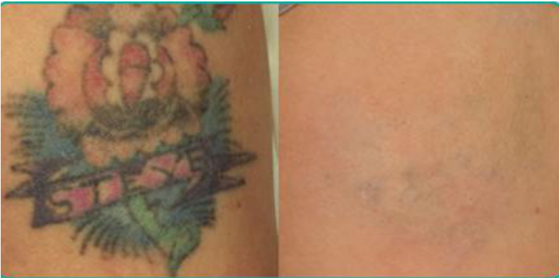 Tattoo Removal Case Result