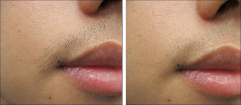 Upper Lip Hair Removal Result