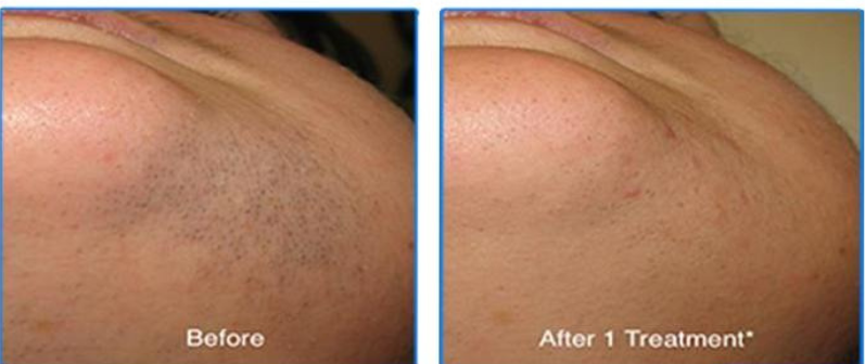 Underarm Hair Removal Result
