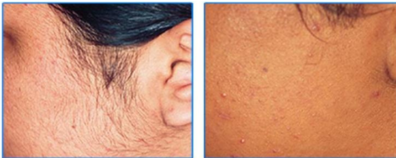Facial & Chin Hair Reduction Result