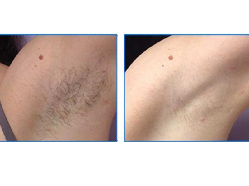 Full Back & Body Reduction Result