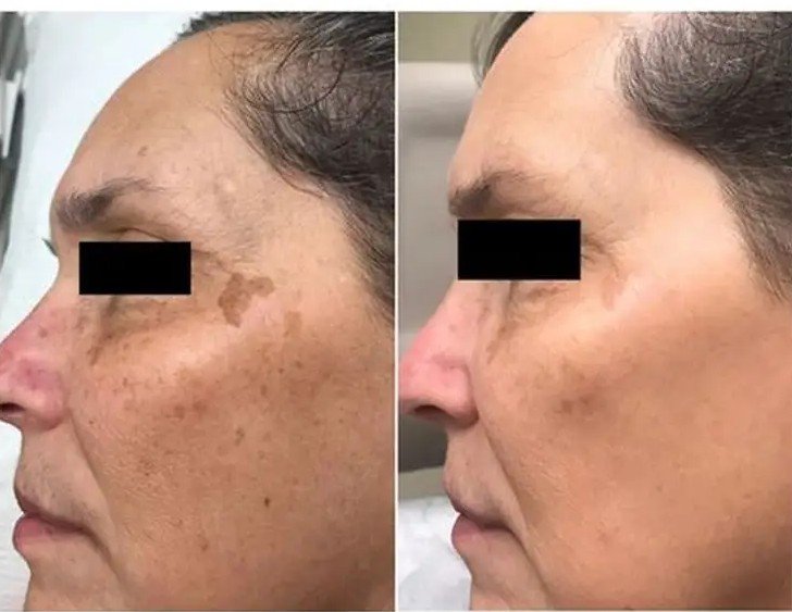 Acne scar and nevus treatment case 1