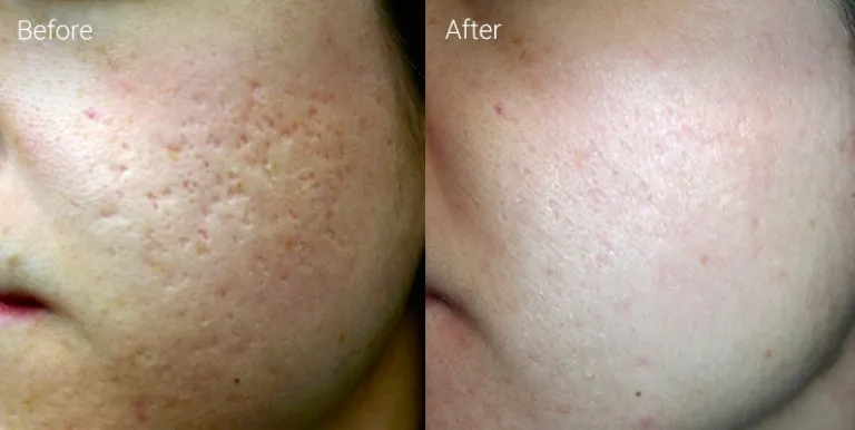 Cosmetic Surgery Before and After Case 2