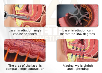 360 Degree Gynae Probe