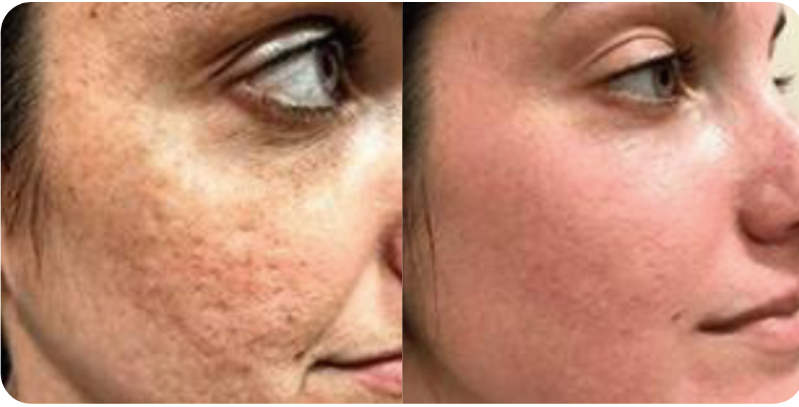 Skin Tags and Benign Skin Lesion Result